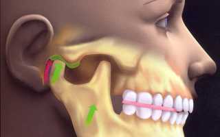 Нарушение функций височно-нижнечелюстного сустава