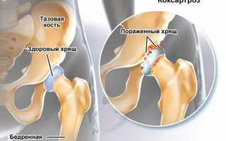 Безоперационное лечение коксартроза тазобедренного сустава