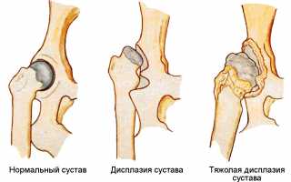 Фиброзная дисплазия костей у ребенка