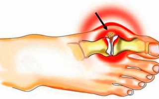 Как вылечить подагру?