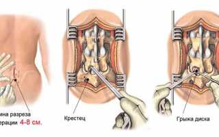 Оперативное лечение грыжи шейного отдела позвоночника