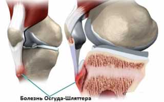 Болезнь Шлаттера у взрослых