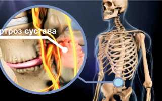 Причины и лечение артроза фасеточных суставов