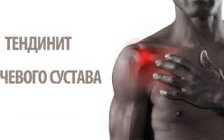 Тендинит плеча