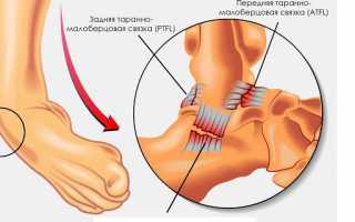 Разрыв голеностопных связок