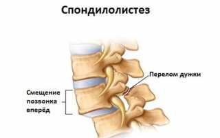 Позвоночный спондилолистез