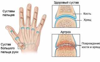 Симптомы и лечение артроза большого пальца руки