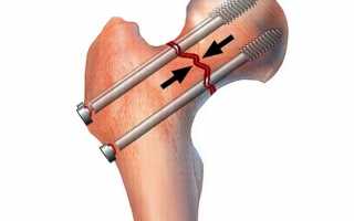 Остеосинтез шейки тазобедренного сустава