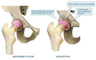 Коксартроз тазобедренного сустава третей степени