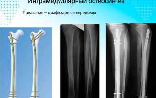 Суть интрамедуллярного остеосинтеза