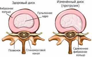 Протрузия дисков поясничного отдела позвоночника