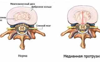 Симптомы и лечение медианной протрузии диска